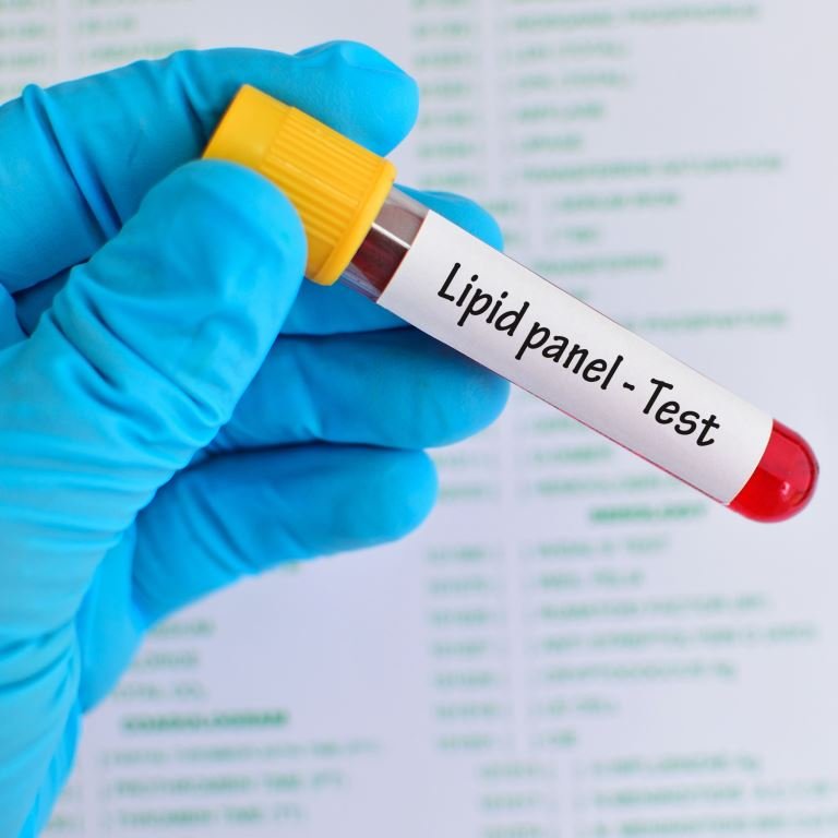Lipid Profile Test